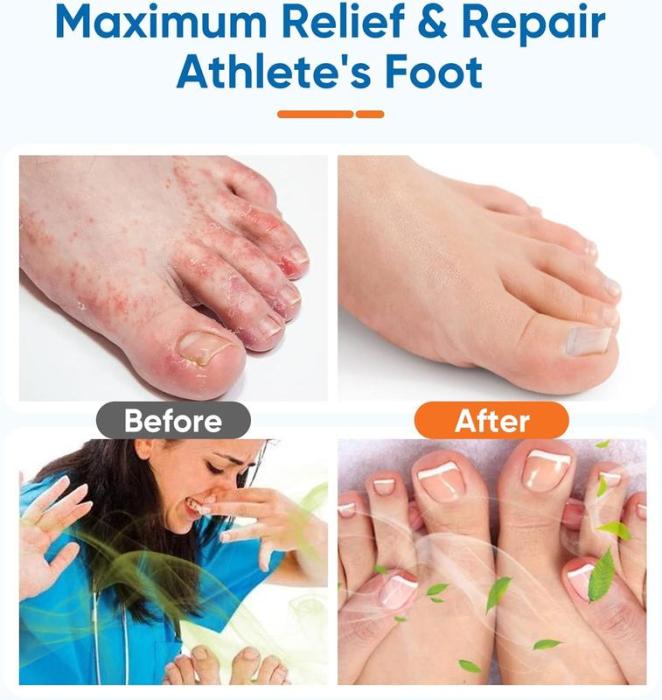 Ximonth Athlete's Foot Spray Treatment